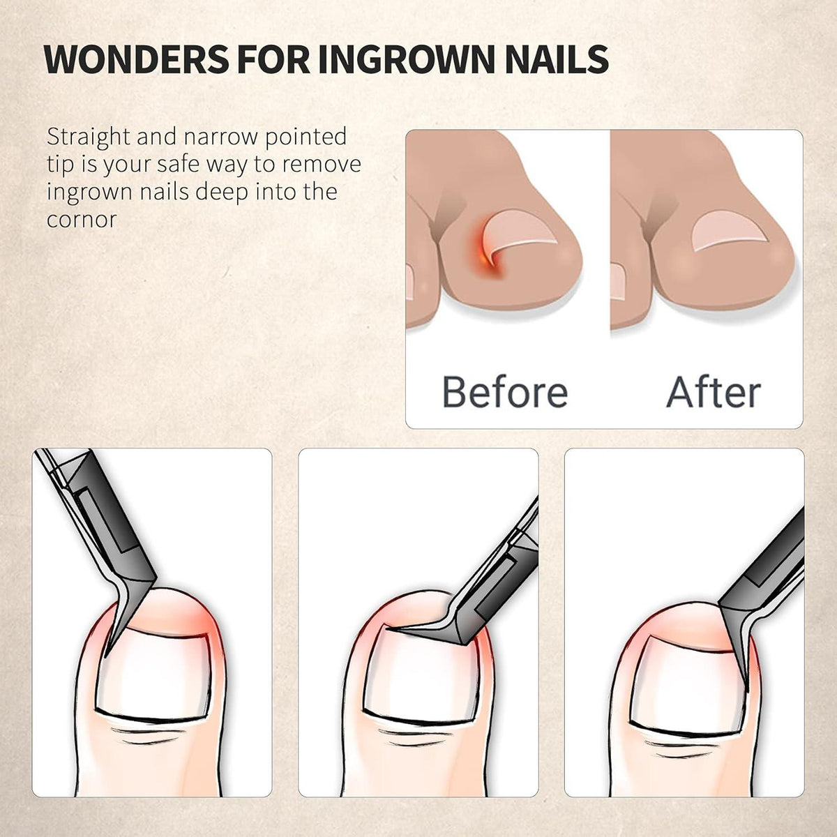 Nagelzange gerade Klinge für eingewachsene Fußnägel und dicke Nägel
