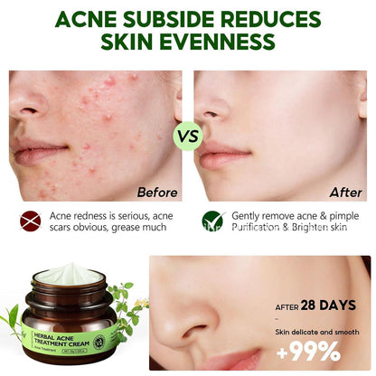 Herbal Anti-Akne Serum und Creme Set Natürliche Pflege